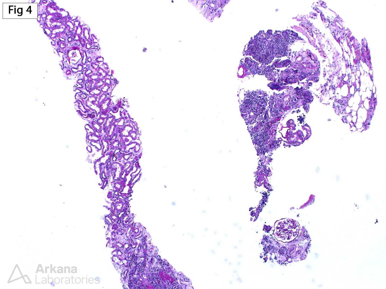 Acute Pyelonephritis