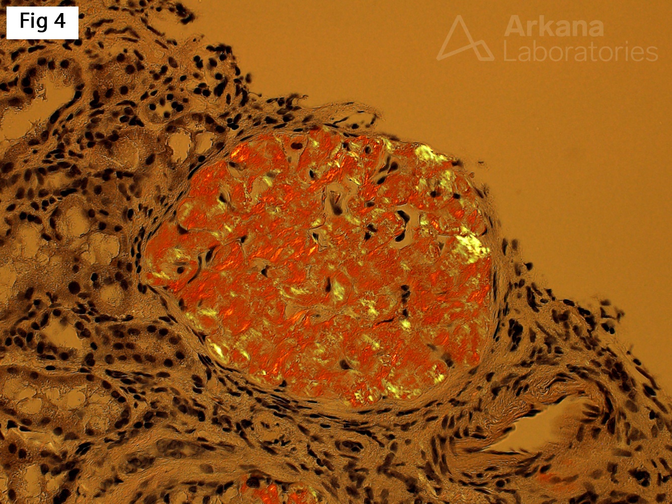 Fibrinogen Aα-chain Amyloidosis