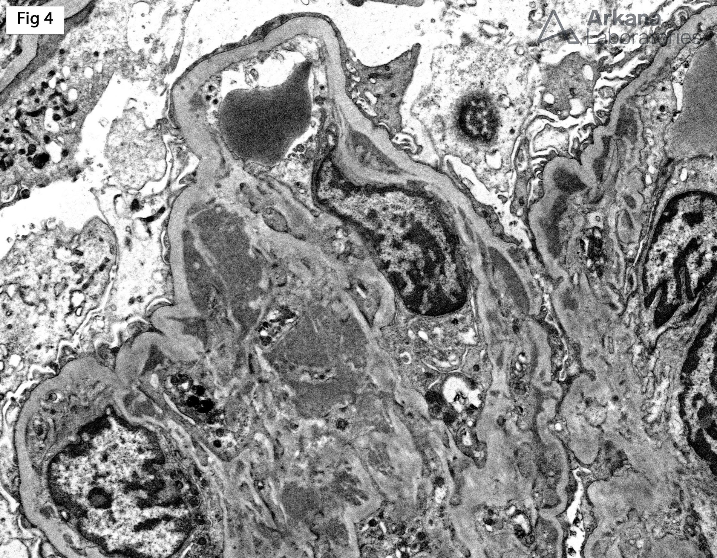 Proliferative Glomerulonephritis with Monoclonal IgG Deposits