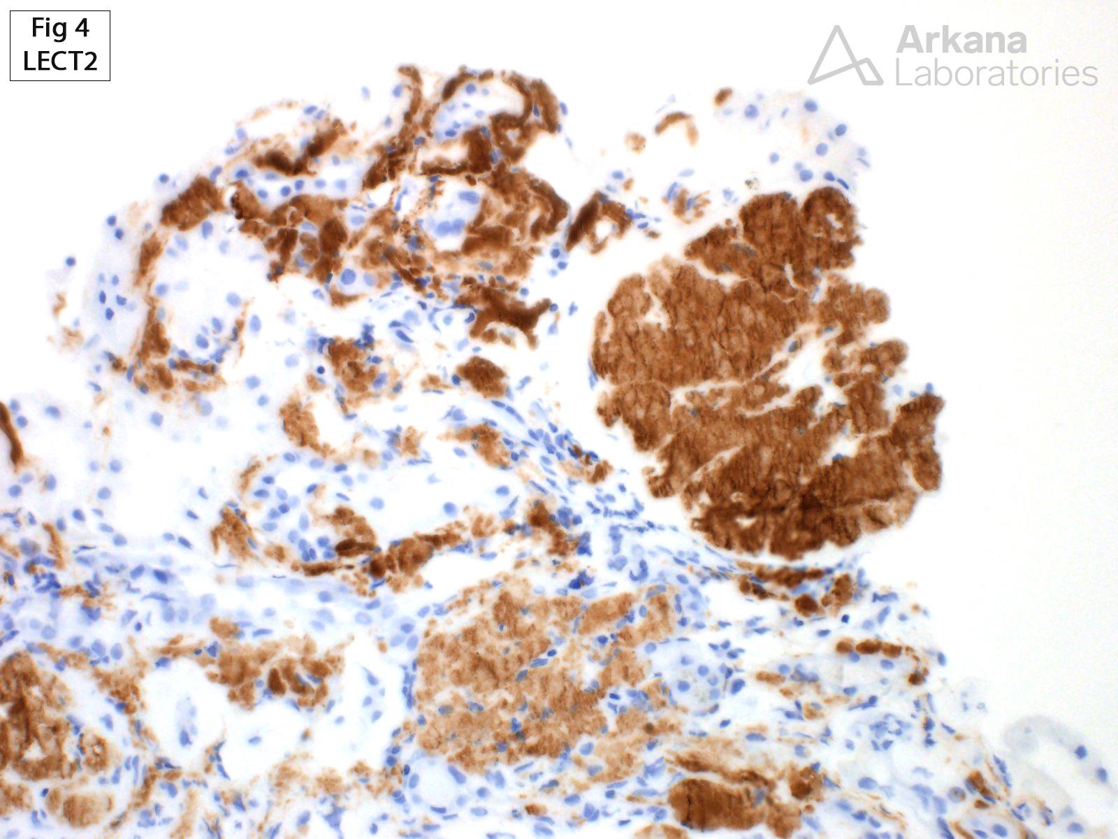 LECT2 Amyloidosis