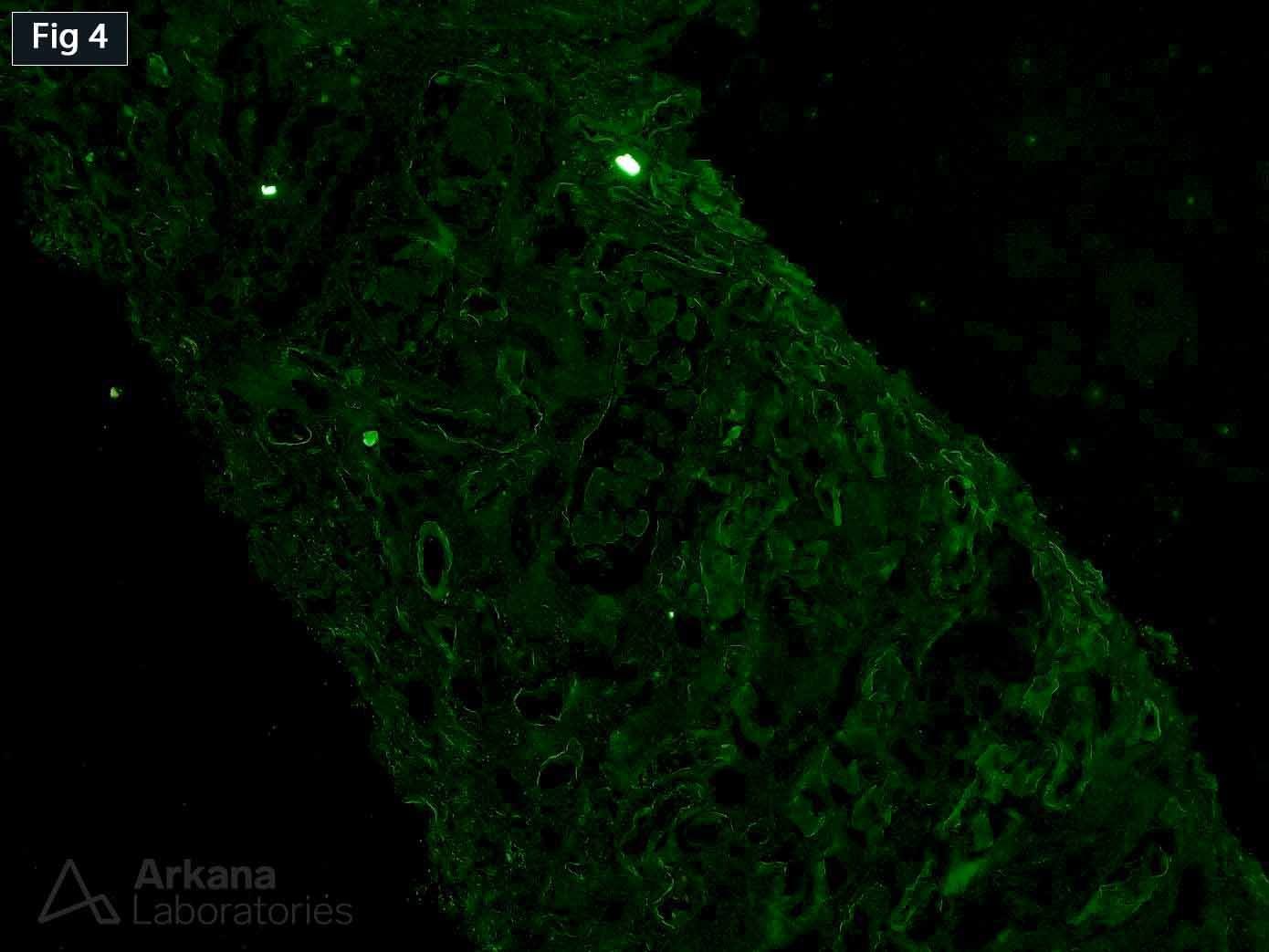 Light Chain Cast Nephropathy with Congo Red Staining