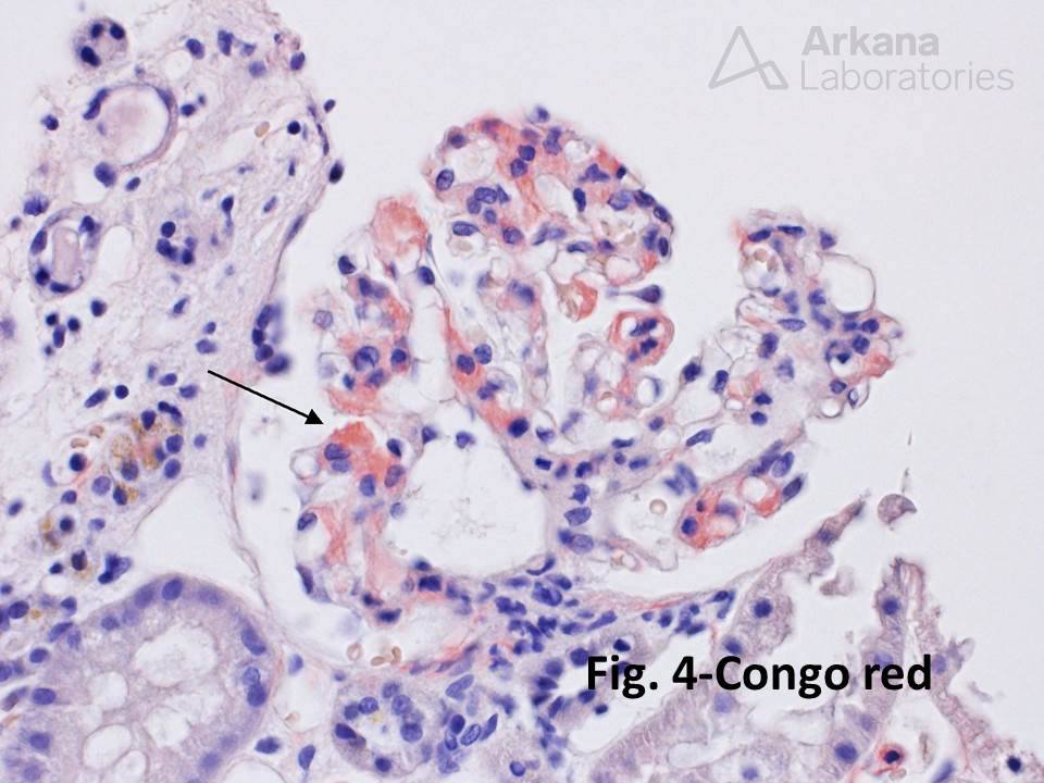 IgA nephropathy