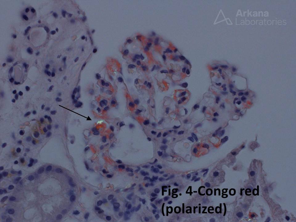 IgA nephropathy