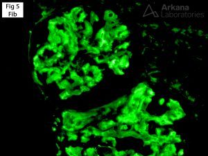 positive fibrinogen staining within the glomeruli, Fibrinogen Aα-chain Amyloidosis
