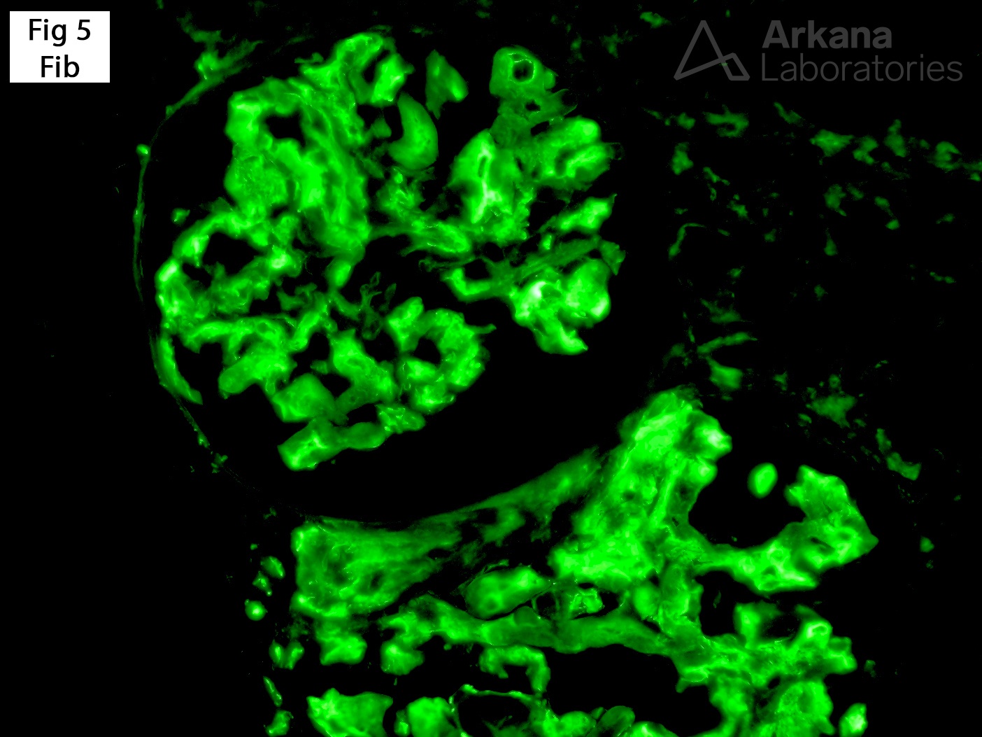 Fibrinogen Aα-chain Amyloidosis