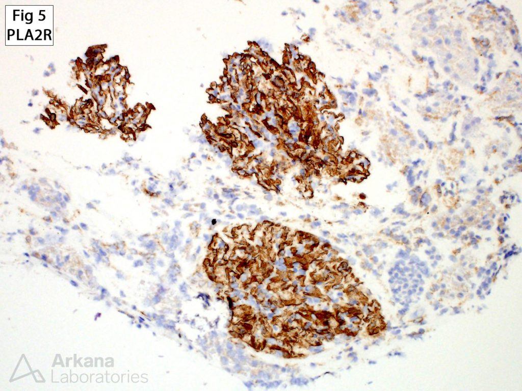 Obesity-Related Glomerulopathy, A PLA2R immunoperoxidase stain is globally positive within the glomerular deposits