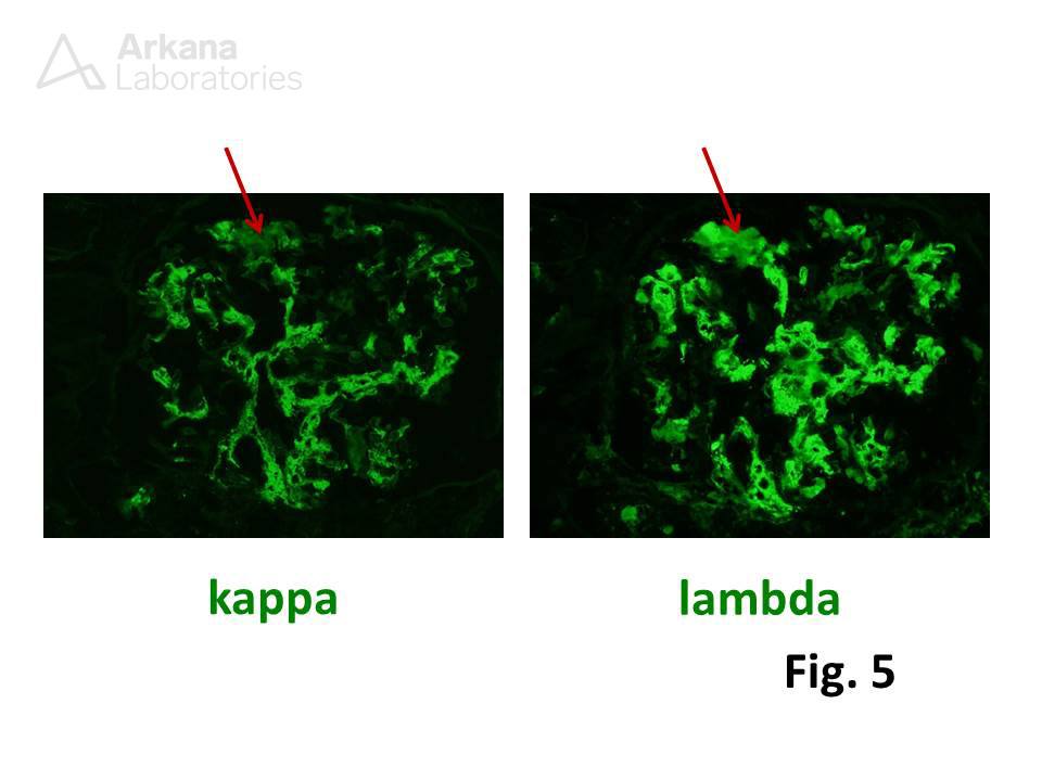 IgA nephropathy