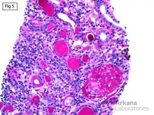 IgA and APOL1-Associated Nephropathy, disappearing and solidified-type globally sclerotic glomeruli along with early microcystic tubular dilatation
