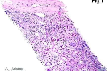 BK virus in renal biopsy at Arkana Laboratories