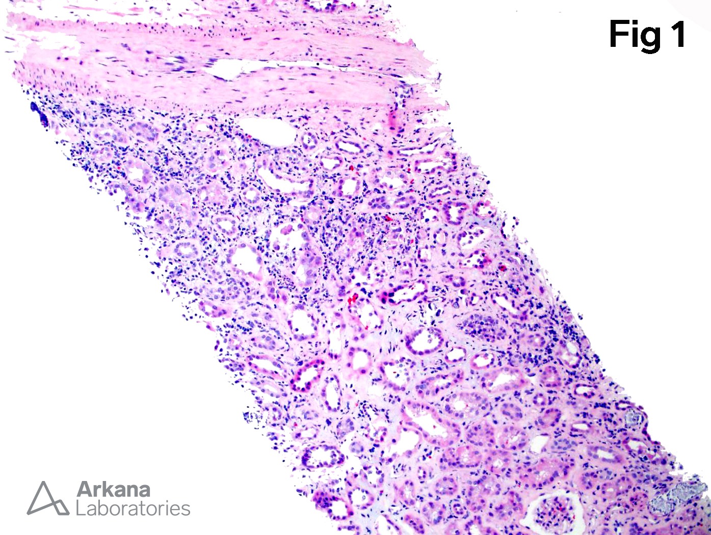 BK virus in renal biopsy at Arkana Laboratories