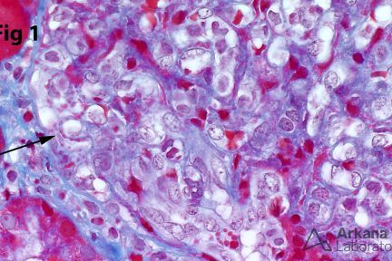 Trichrome Staining in Deposits