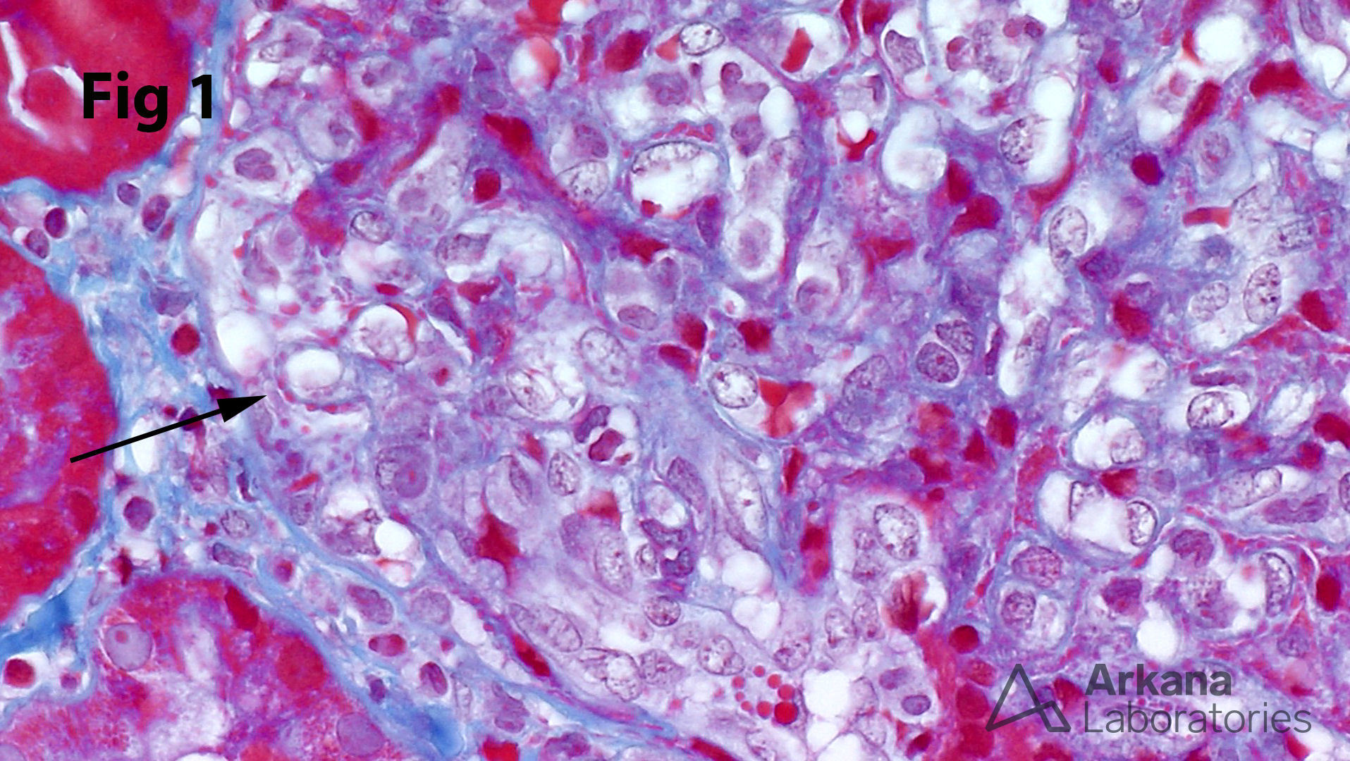 Trichrome Staining in Deposits