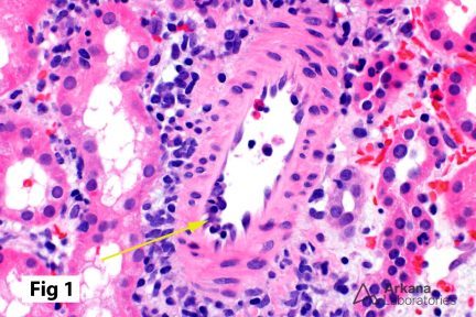 Intimal Arteritis