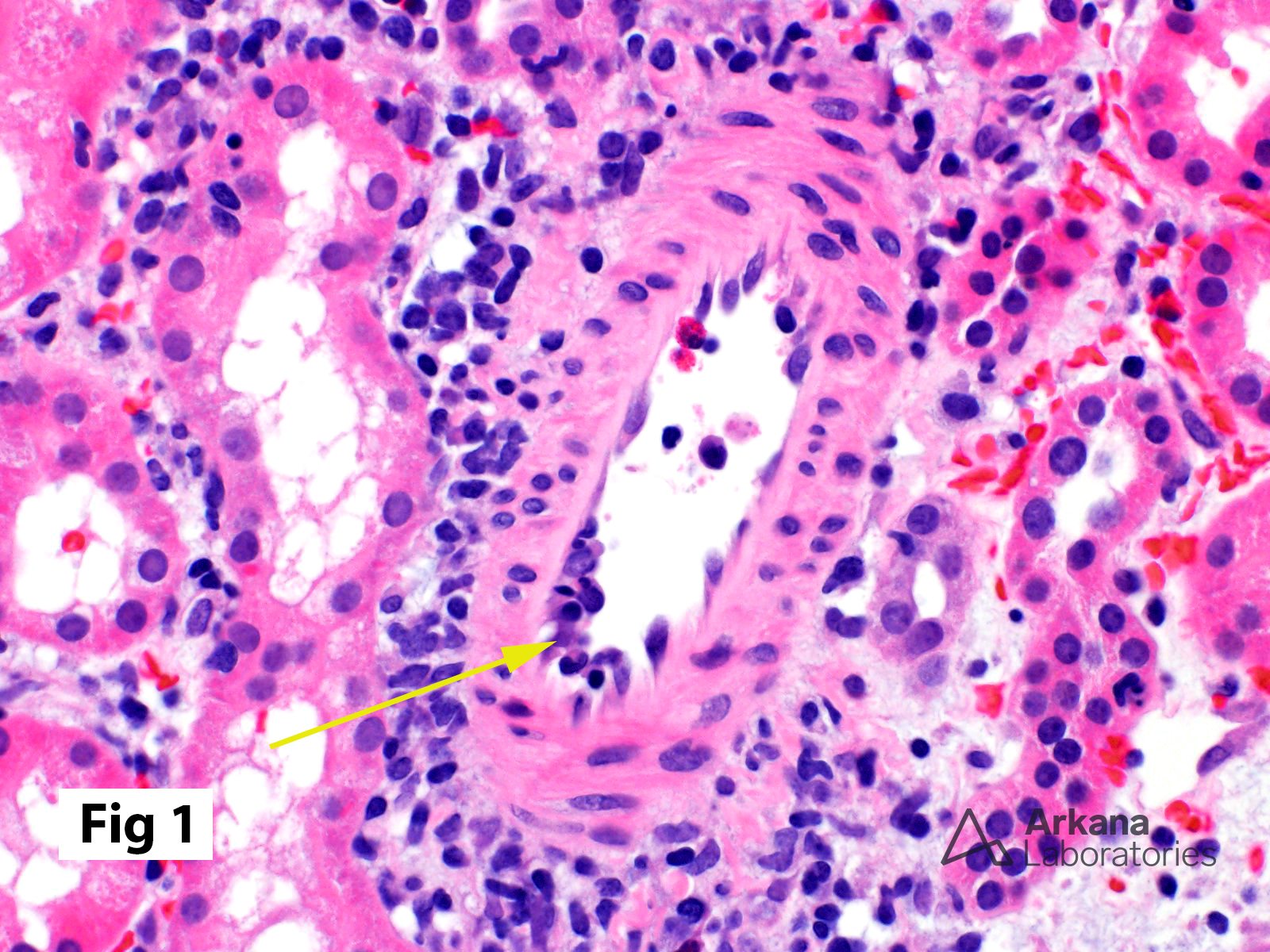 Intimal Arteritis