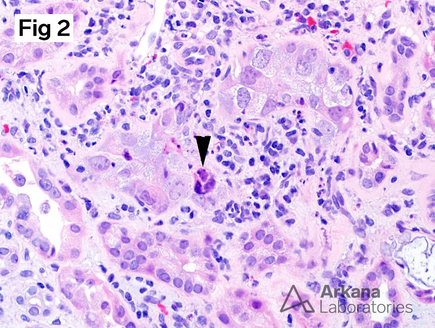 atypical nuclei including an apoptotic body
