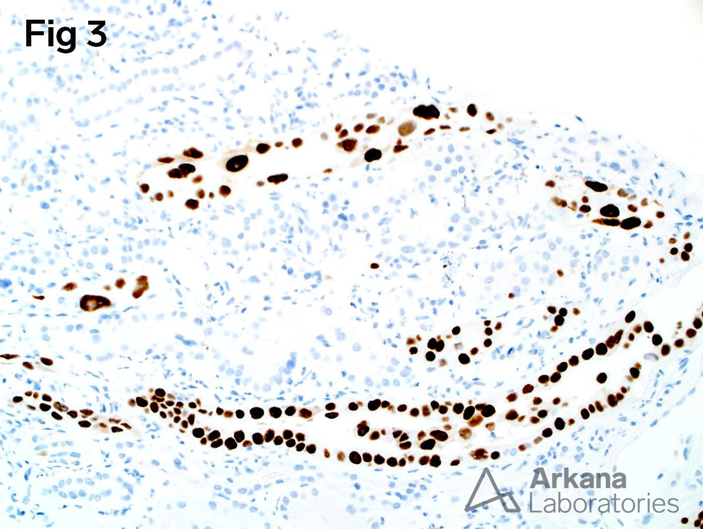 SV40 IHC stain for polyoma virus that is positive in many nuclei, BK nephritis