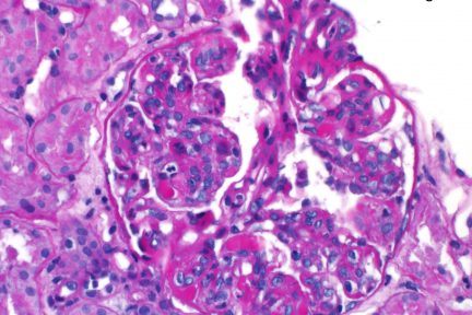 Cryoglobulinemic Glomerulonephritis