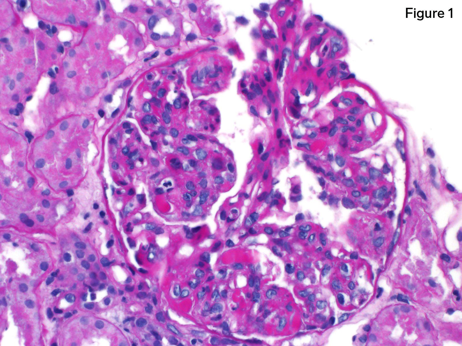 Cryoglobulinemic Glomerulonephritis