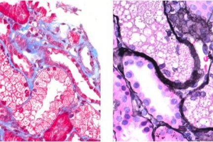 calcineurin inhibitor toxicity