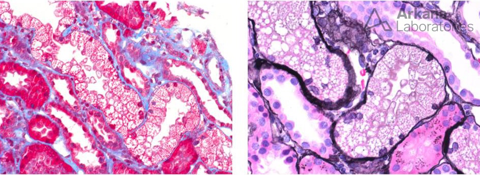 calcineurin inhibitor toxicity