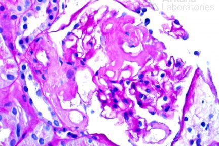 AL-Type Amyloidosis, teaching point, arkana laboratories, renal pathology, kidney biopsy