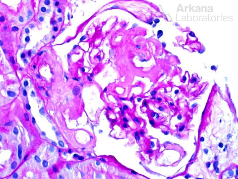 AL-Type Amyloidosis | Teaching Point | Arkana Laboratoriesf
