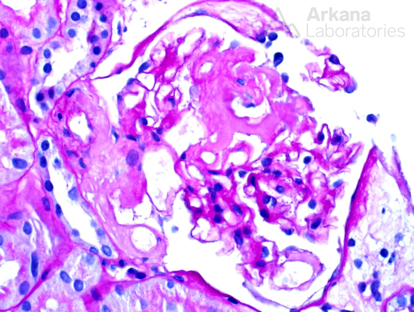 AL-Type Amyloidosis, teaching point, arkana laboratories, renal pathology, kidney biopsy