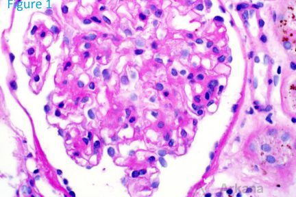 renal hemosiderosis, arkana laboratories, teaching point, renal pathology