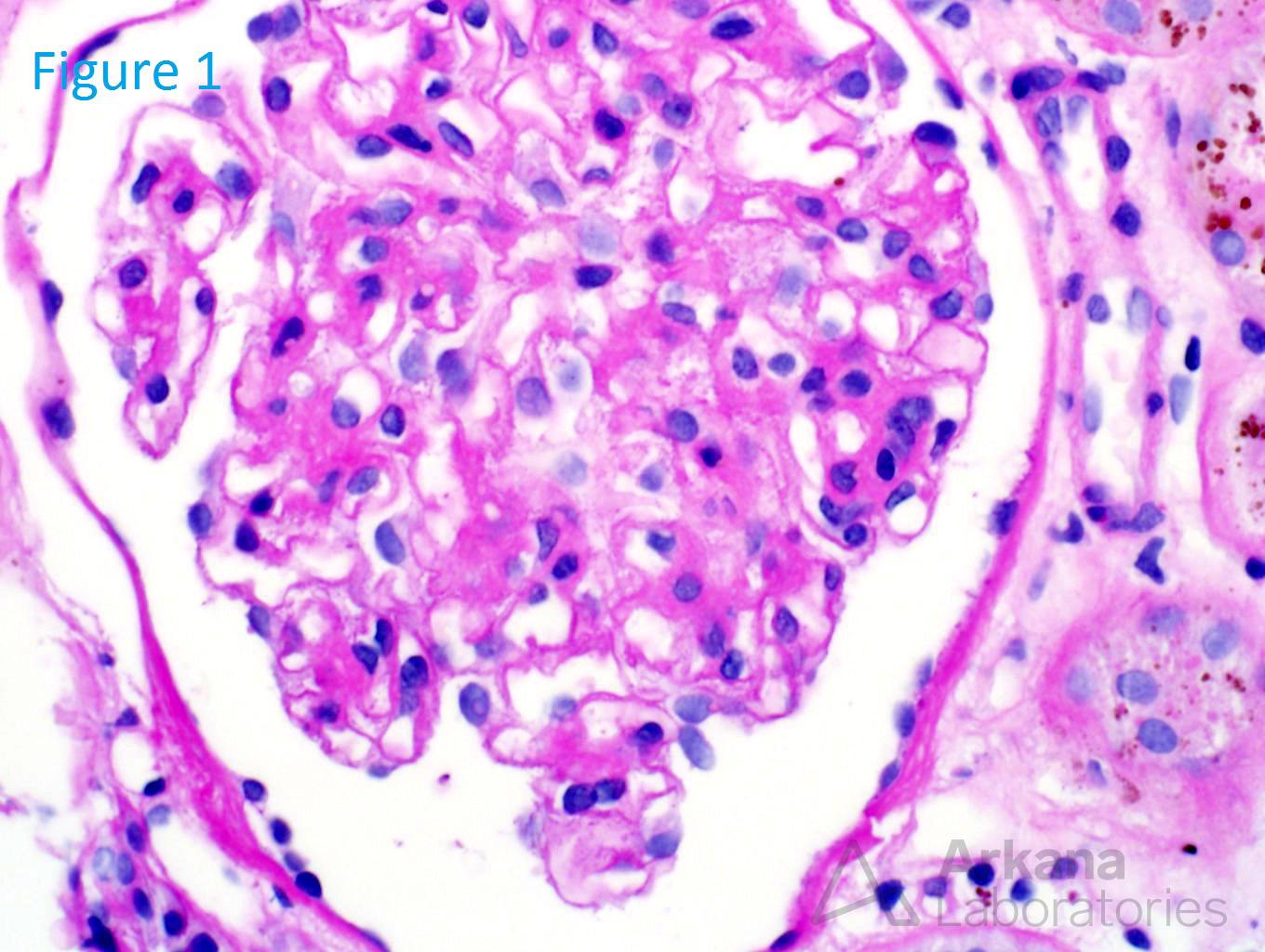 renal hemosiderosis, arkana laboratories, teaching point, renal pathology