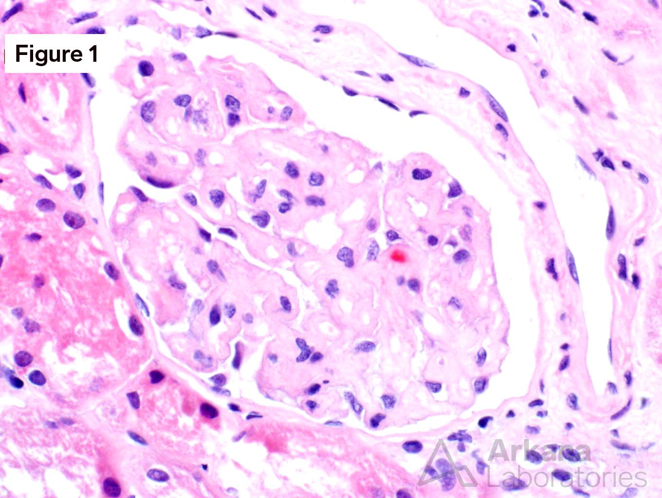 VEGF, VEGF inhibitor, arkana laboratories, renal pathology