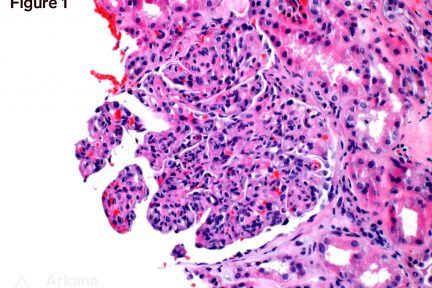 Acute kidney injury, chryoglobulinemia, glomerulonephritis, hyaline thrombi, masked deposits, paraffin immunofluorescence, Cryoglobulinemic Glomerulonephritis