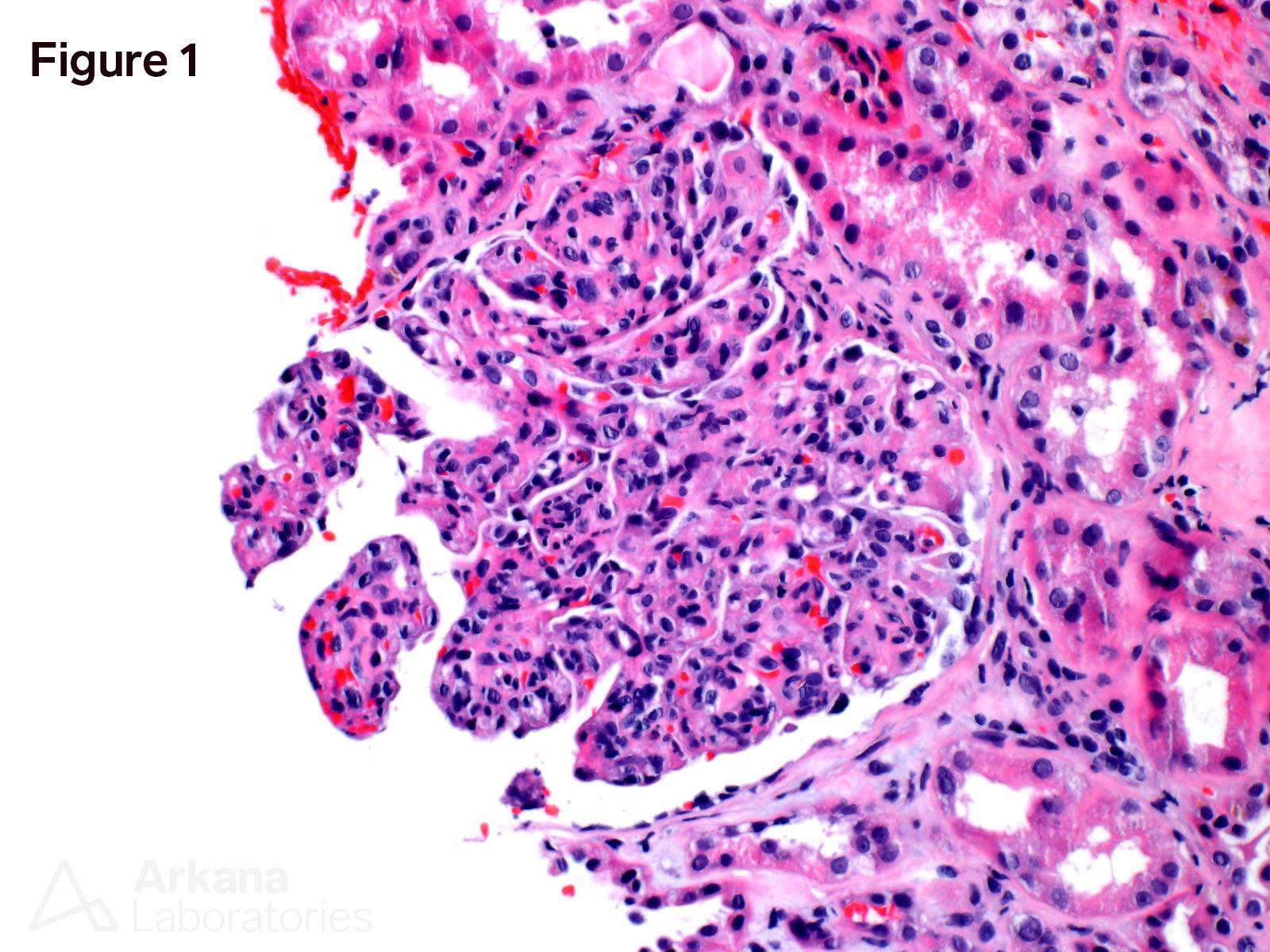 Acute kidney injury, chryoglobulinemia, glomerulonephritis, hyaline thrombi, masked deposits, paraffin immunofluorescence, Cryoglobulinemic Glomerulonephritis