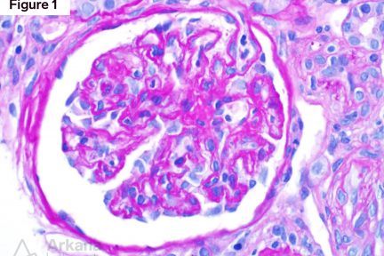 Acute kidney injury, anti-centromere antibodies, ischemia, schistoctes, scleroderma renal crisis, thrombotic microangiopathy, scleroderma