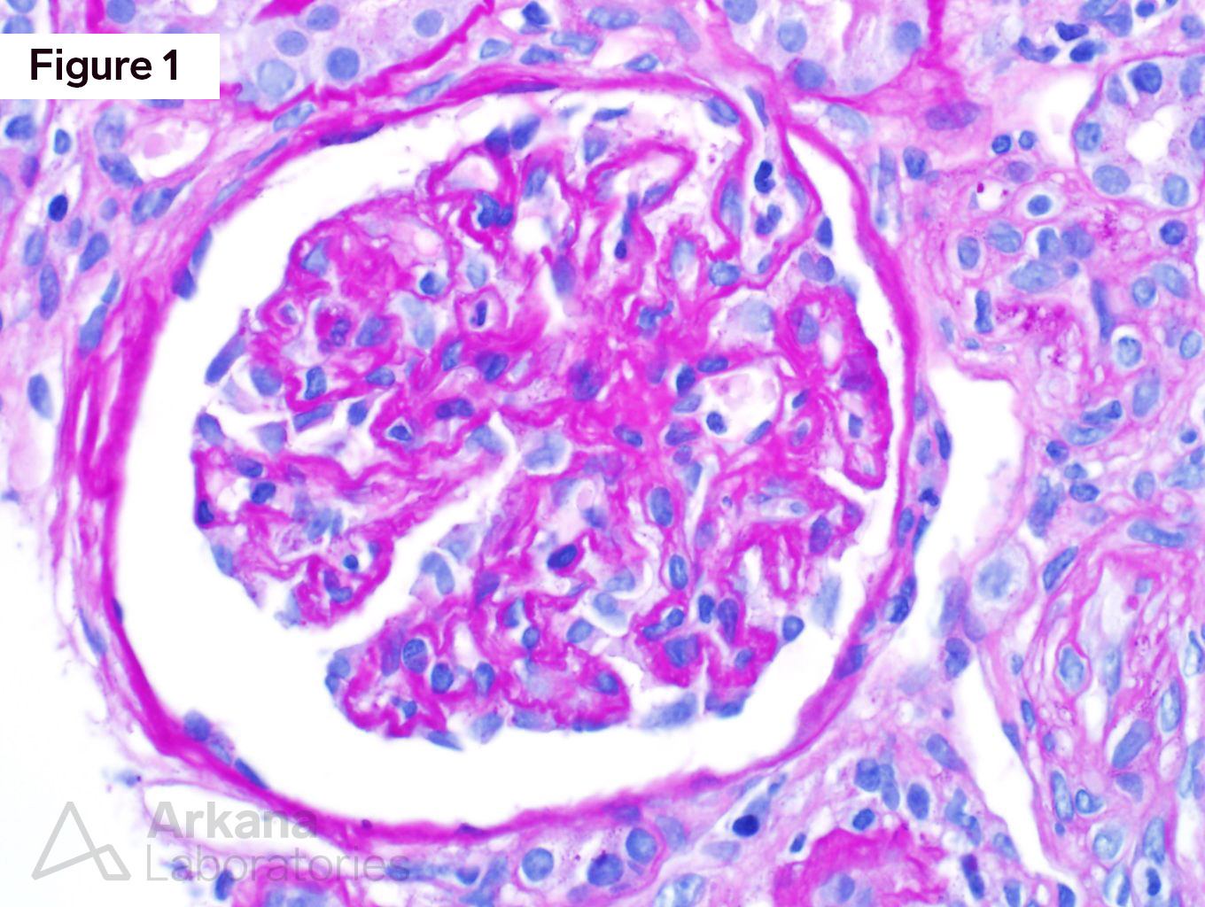 Acute kidney injury, anti-centromere antibodies, ischemia, schistoctes, scleroderma renal crisis, thrombotic microangiopathy, scleroderma