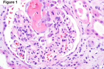 focal fibrinoid necrosis, IgA, Crescentic IgA Nephropathy, chronic kidney disease, Arkana Laboratories