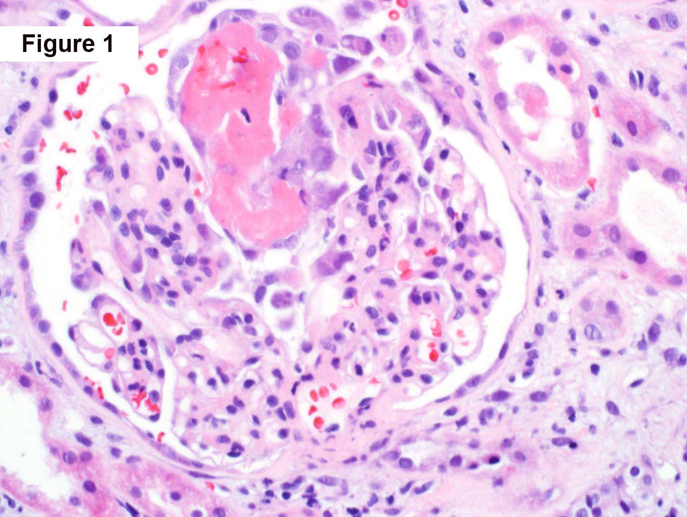 focal fibrinoid necrosis, IgA, Crescentic IgA Nephropathy, chronic kidney disease, Arkana Laboratories