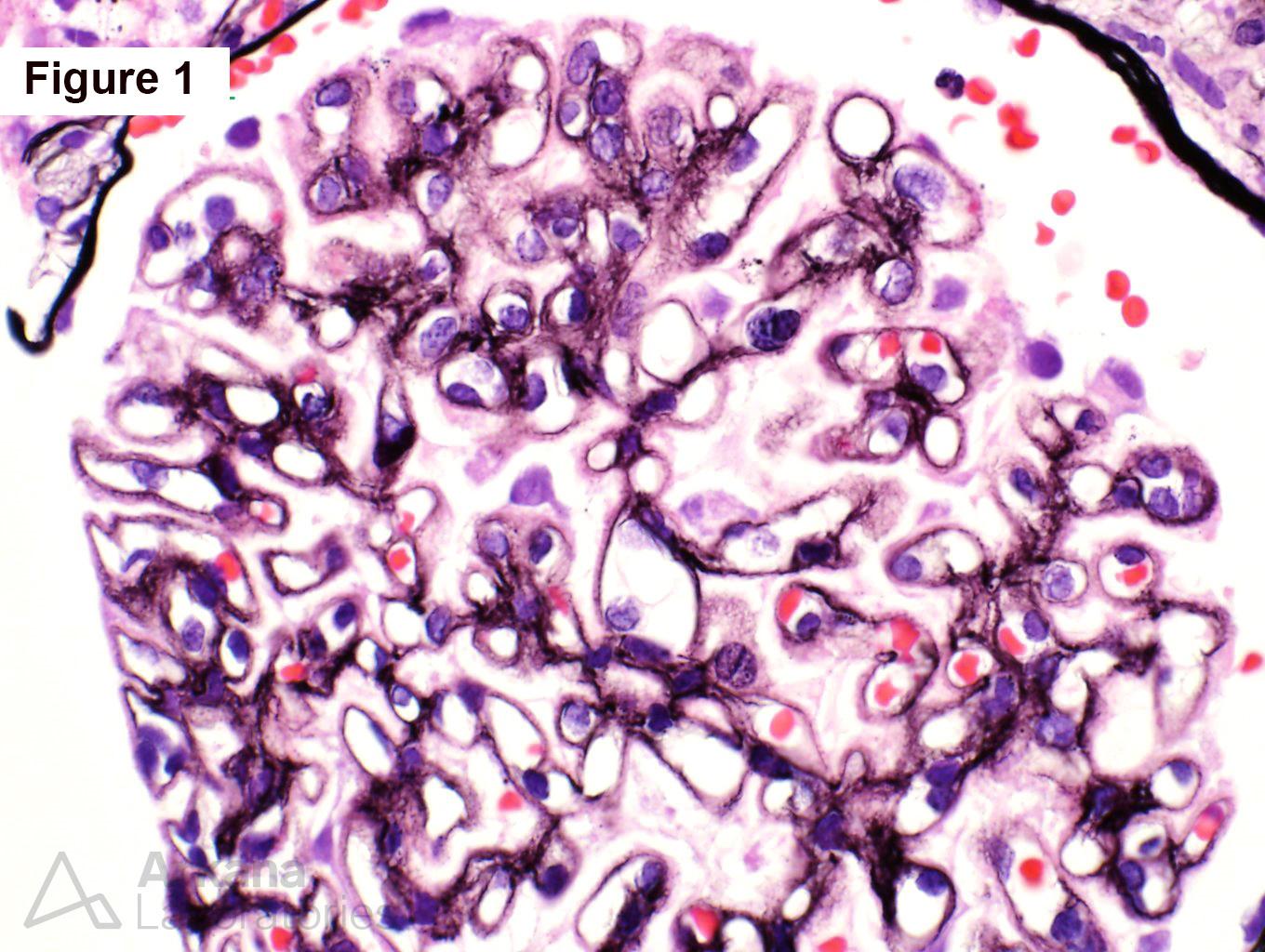 Membranous Nephropathy, renal diseases, kidney biopsy, arkana laboratories