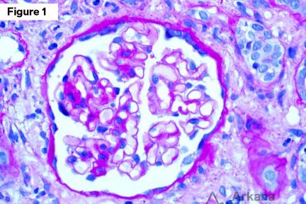 Kappa Light Chain Cast Nephropathy, teaching point, Arkana Laboratories, renal pathology