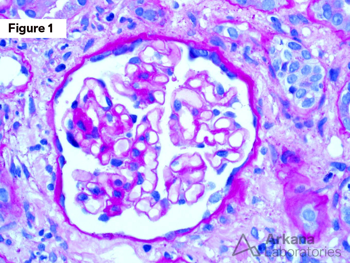 Kappa Light Chain Cast Nephropathy