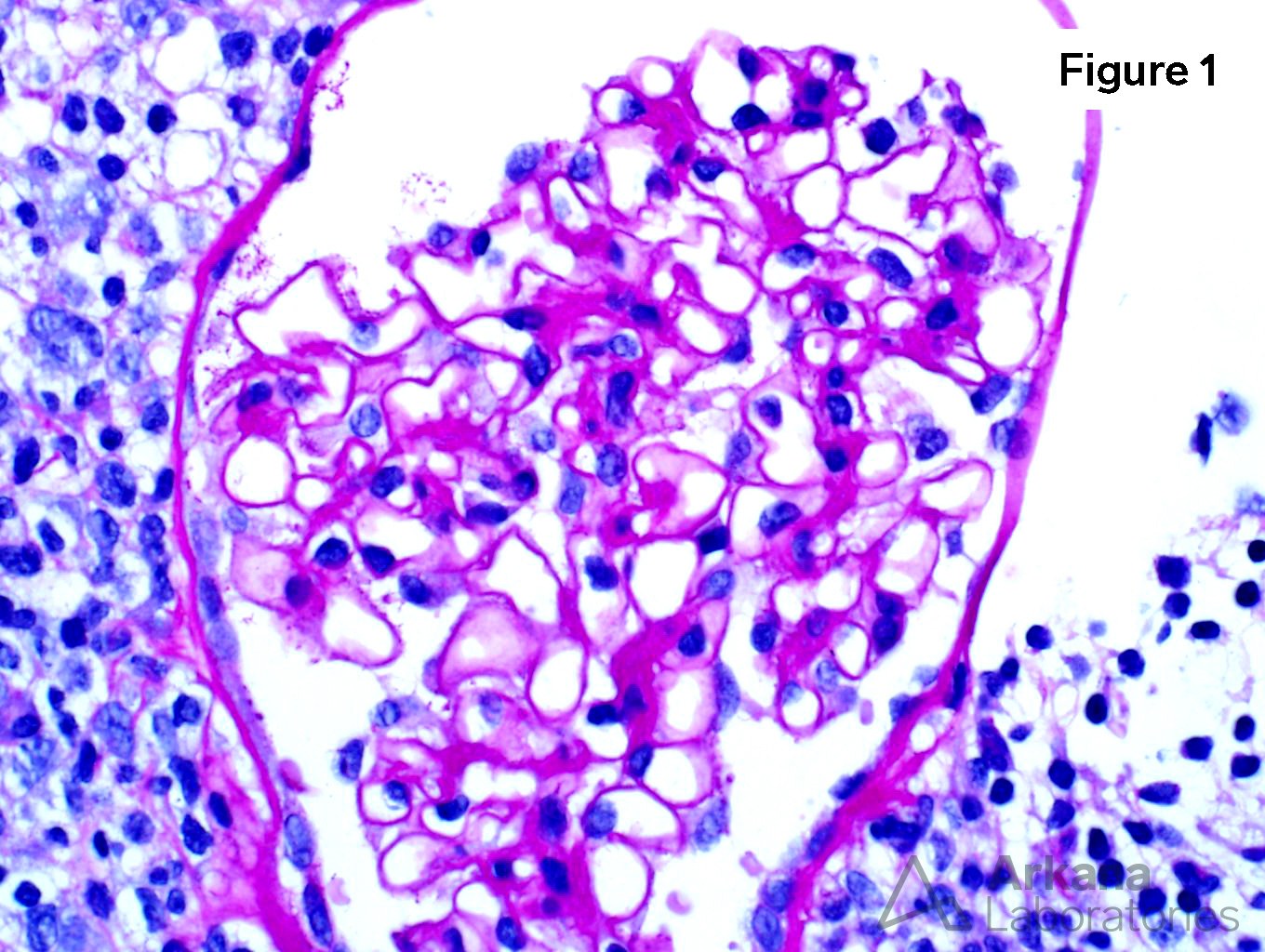 BK Nephritis, renal biopsy, kidney pathology, arkana laboratories