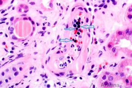 Nucleated Red Blood, teaching point, arkana laboratories