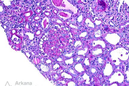 Diffuse Mesangial Sclerosis