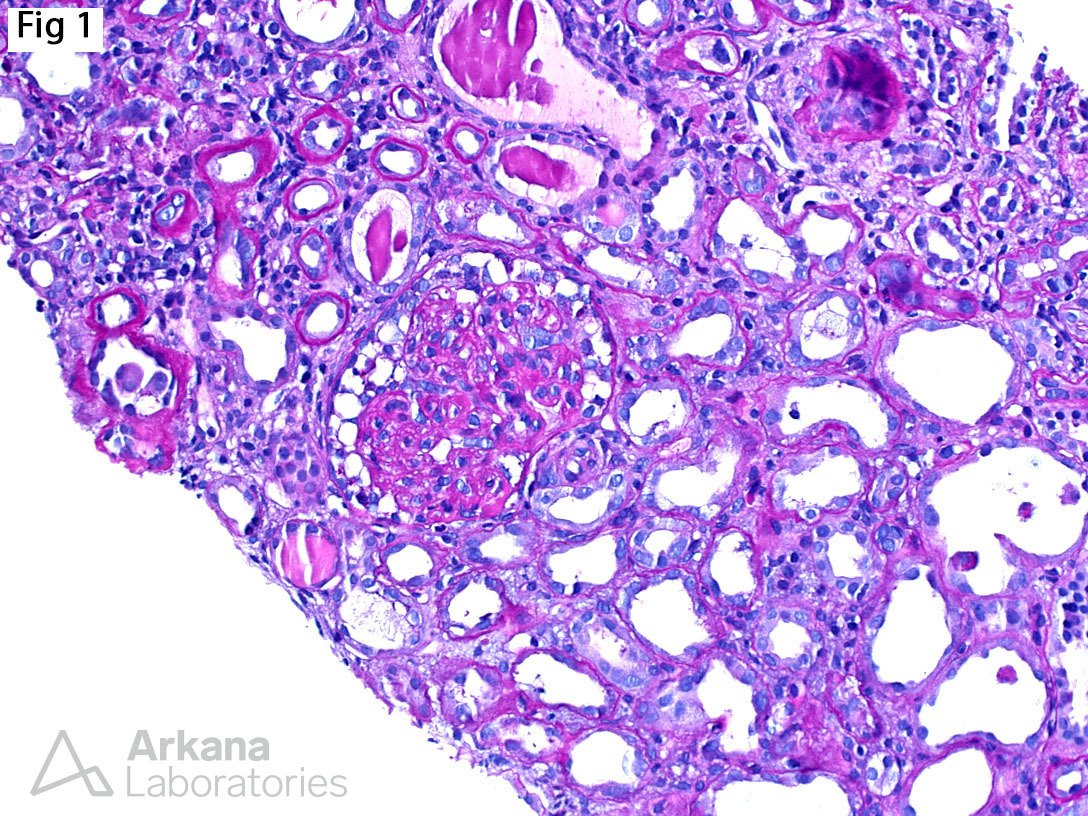 Diffuse Mesangial Sclerosis