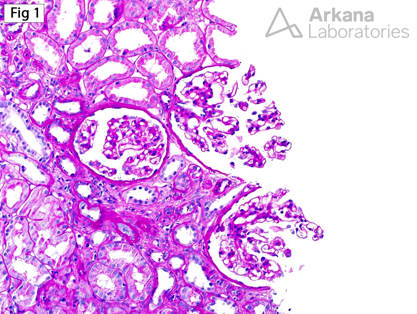 Alport Syndrome