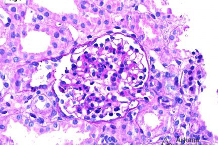 Diffuse Mesangial Hypercellularity