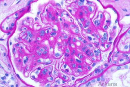 IgA Dominant Infection-Associated Glomerulonephritis, renal pathology