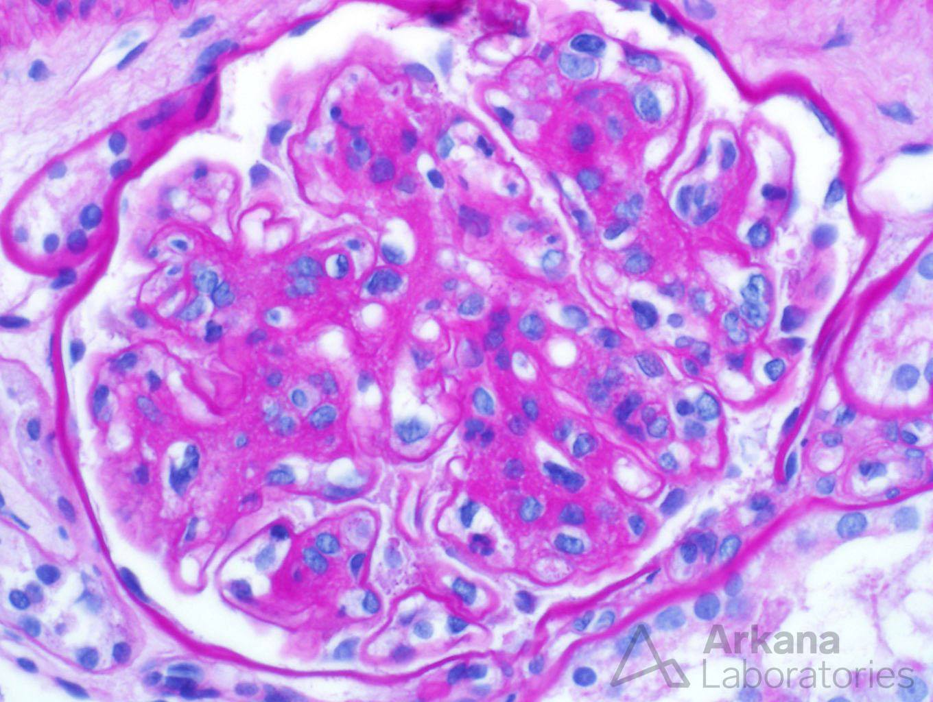IgA Dominant Infection-Associated Glomerulonephritis, renal pathology