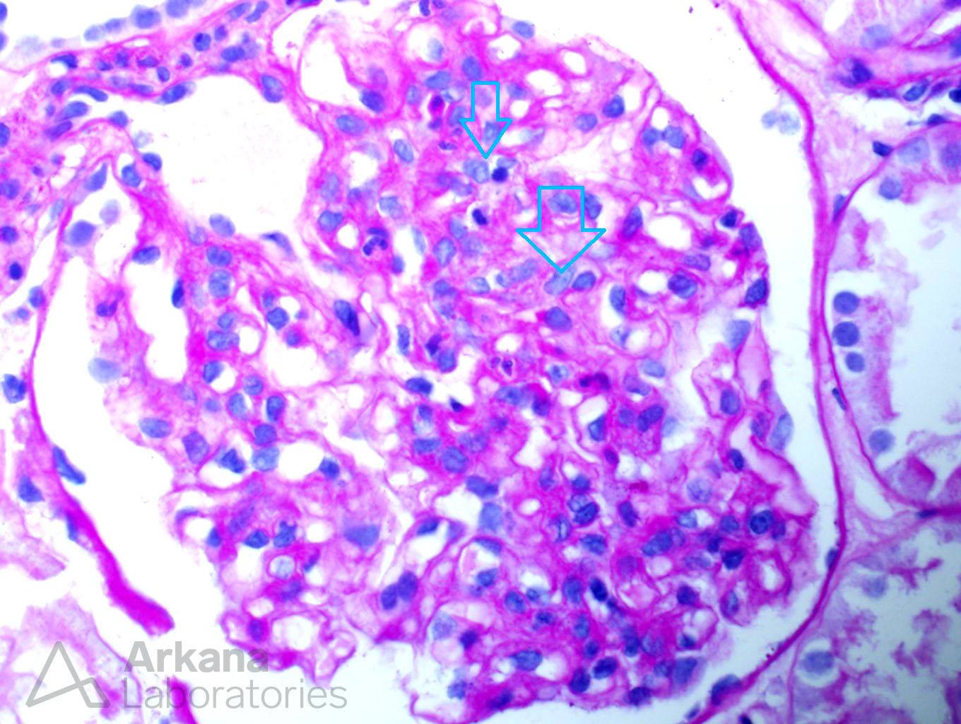 Infection-Associated Glomerulonephritis