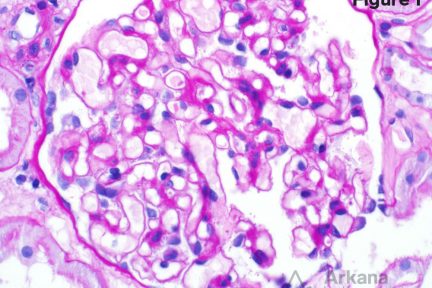 Minimal Change Disease, teaching point, arkana laboratories, renal pathology