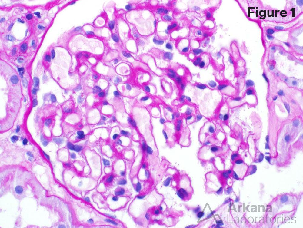 Minimal Change Disease, teaching point, arkana laboratories, renal pathology